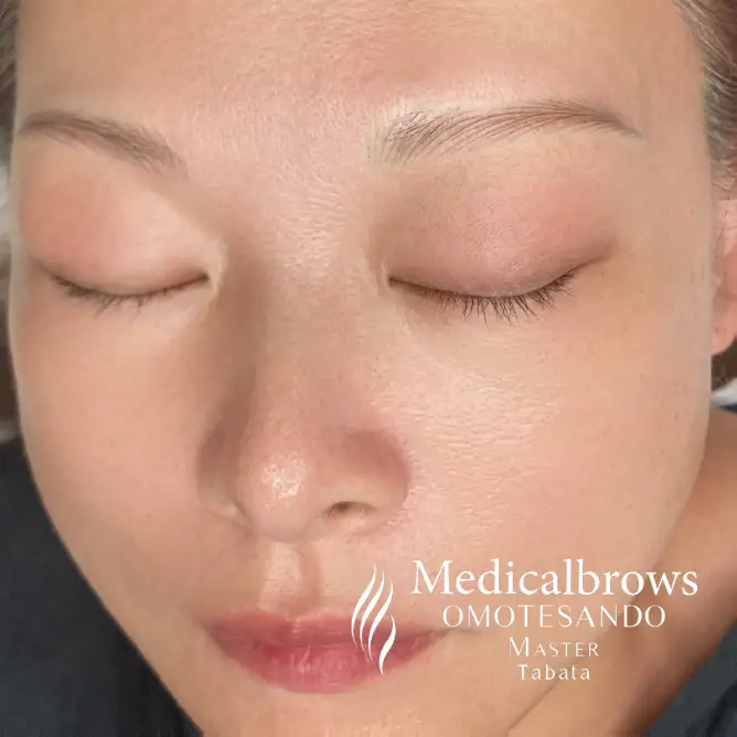 田畑 アートメイク症例写真