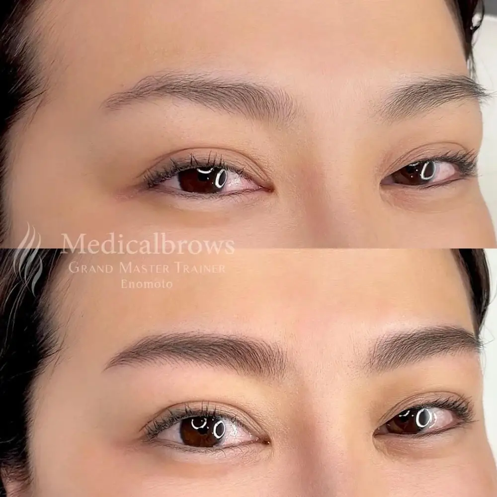 ヘアストローク（マシン彫り）症例1