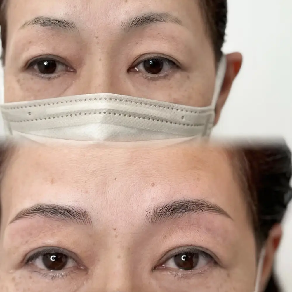 ヘアストローク（マシン彫り）症例2