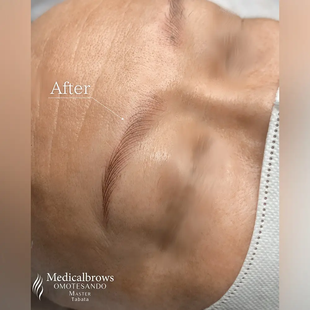 ヘアストローク（マシン彫り）症例3