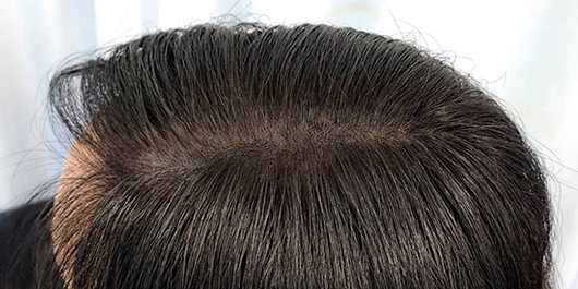 スカルプエアーメディカル 参考イメージ