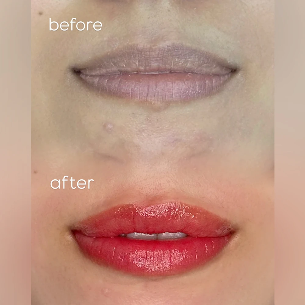 フルリップ 症例3