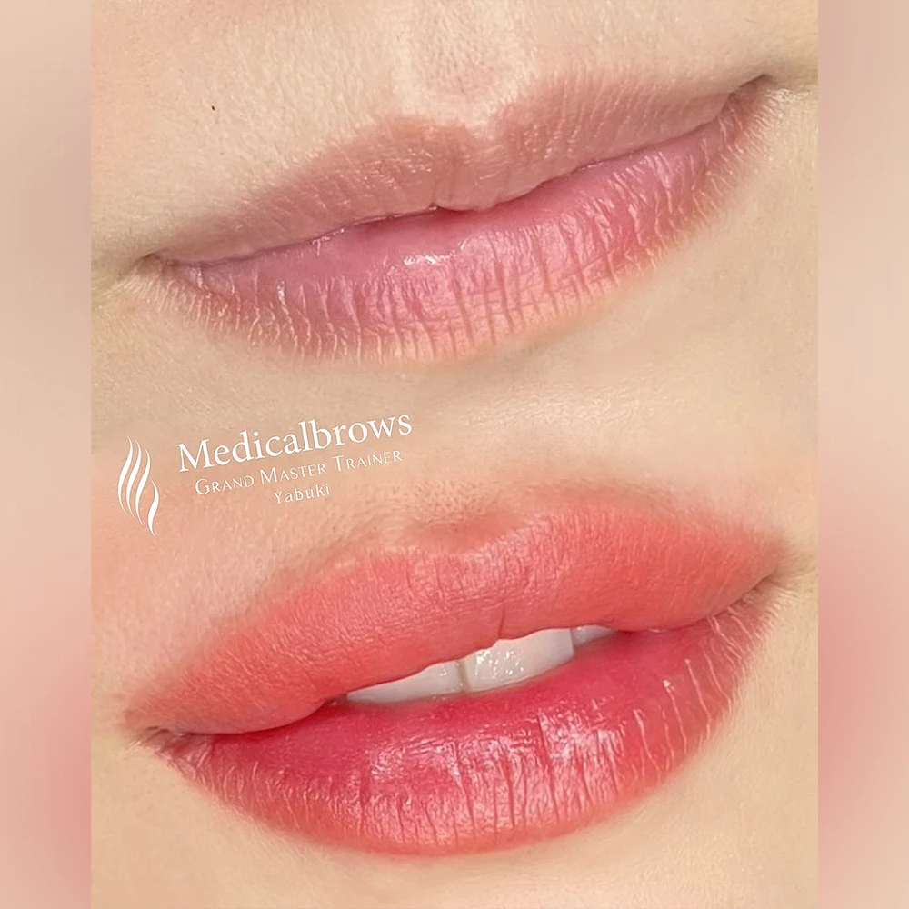 自然なオーバーリップ 症例2