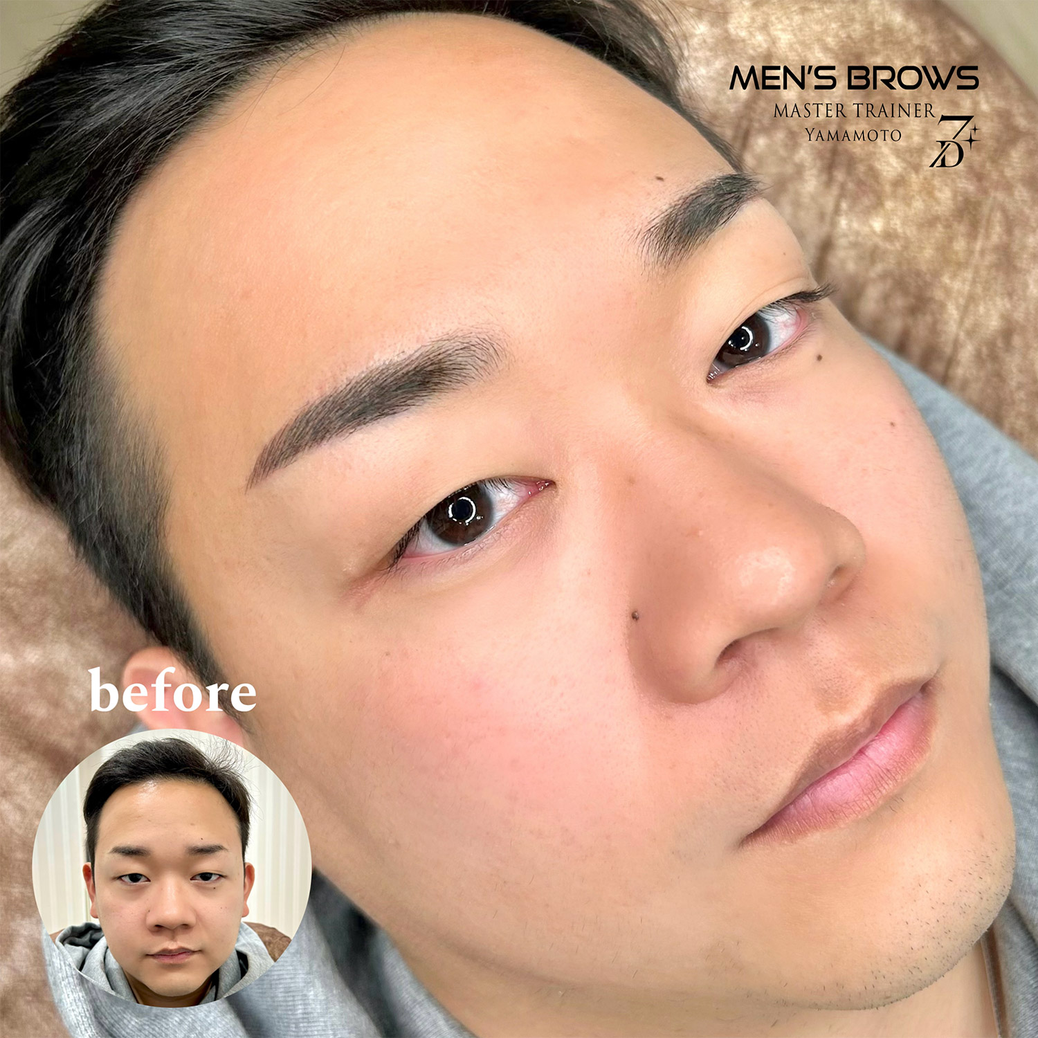 メディカルブロー 山本 症例写真3