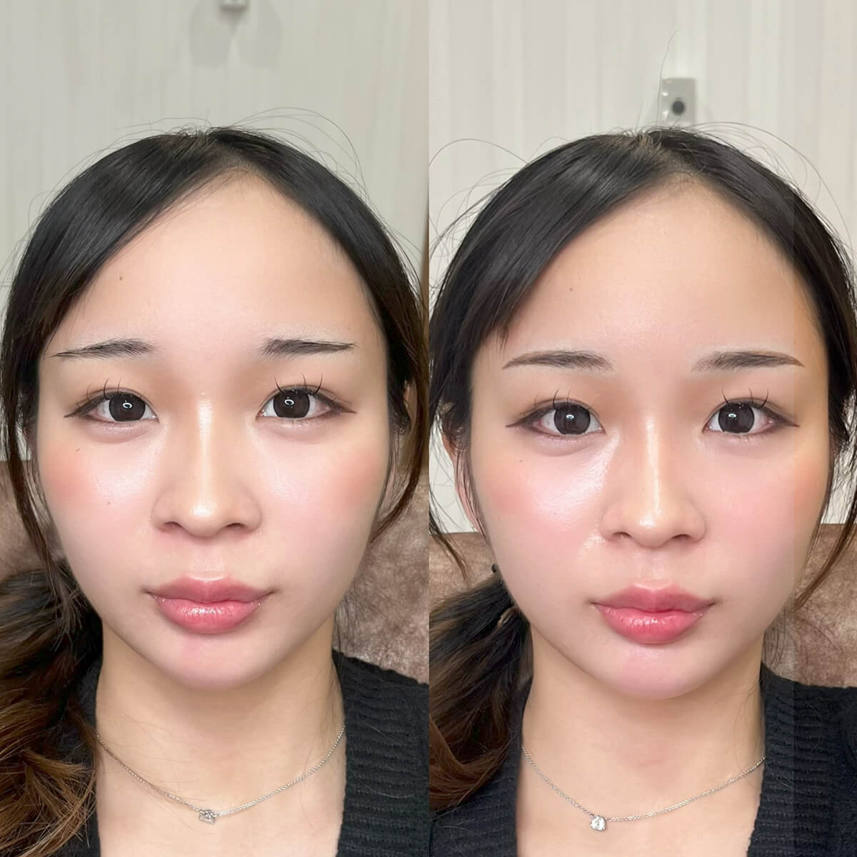 メディカルブロー 片峰 症例写真1