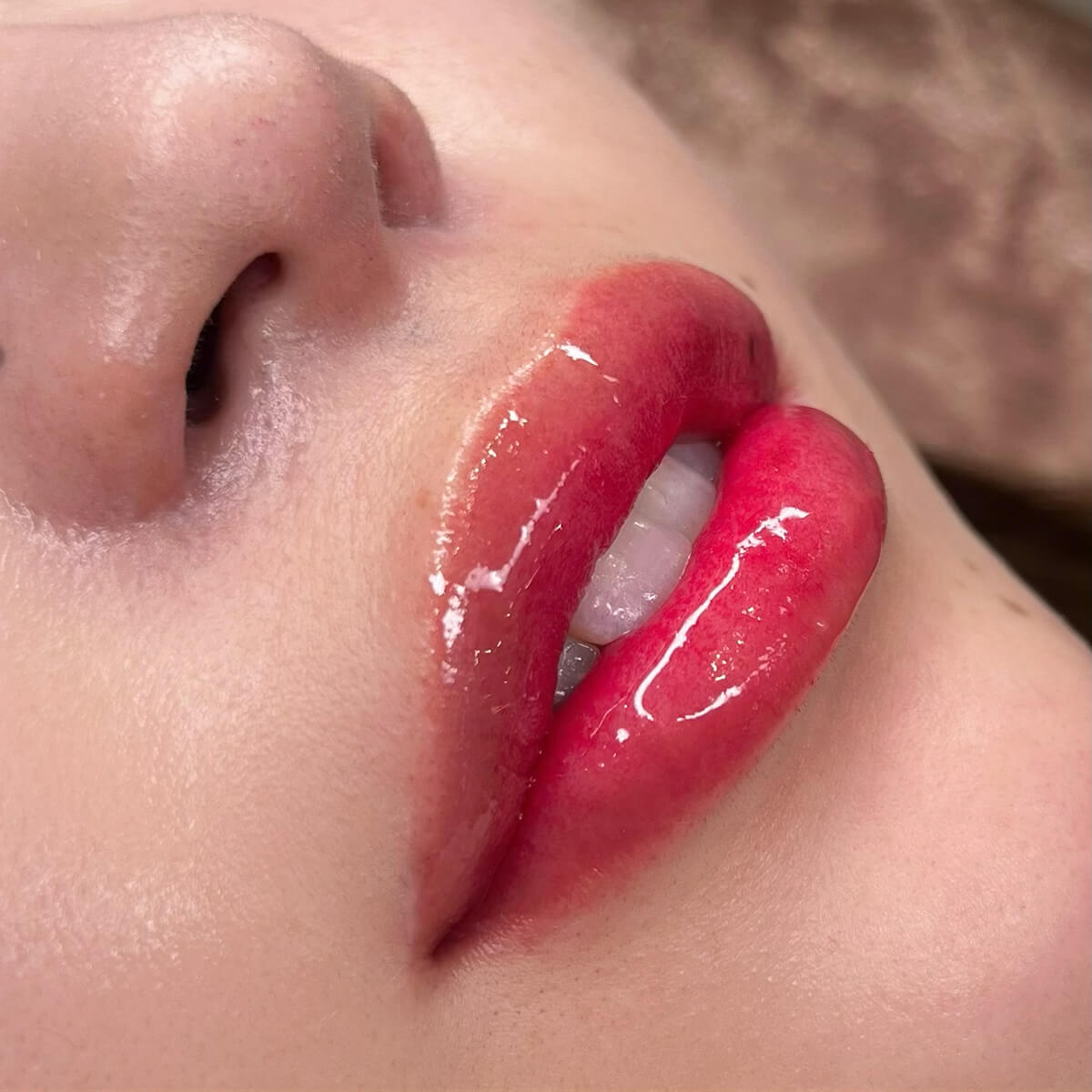 メディカルブロー 片峰 症例写真2