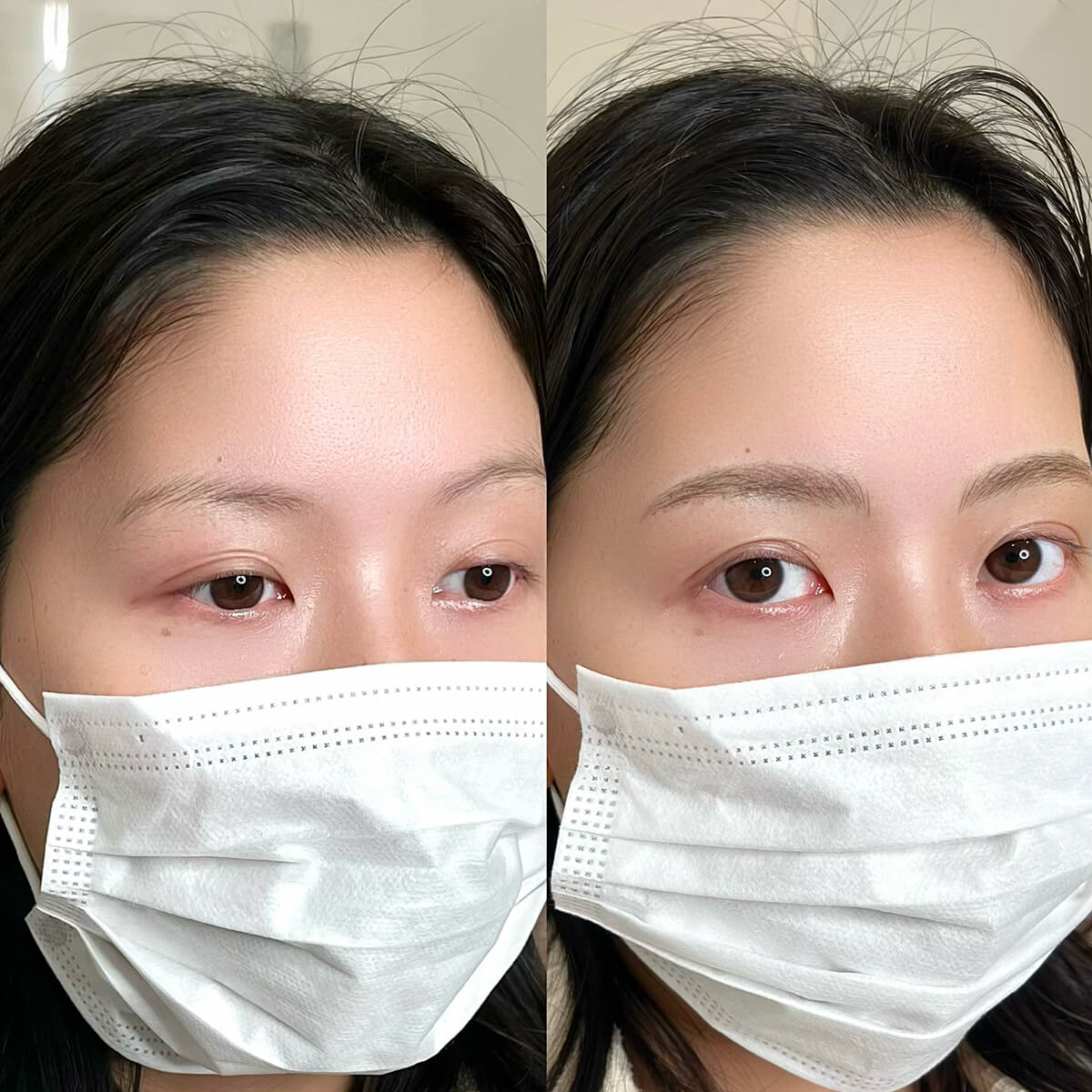 メディカルブロー 片峰 症例写真3