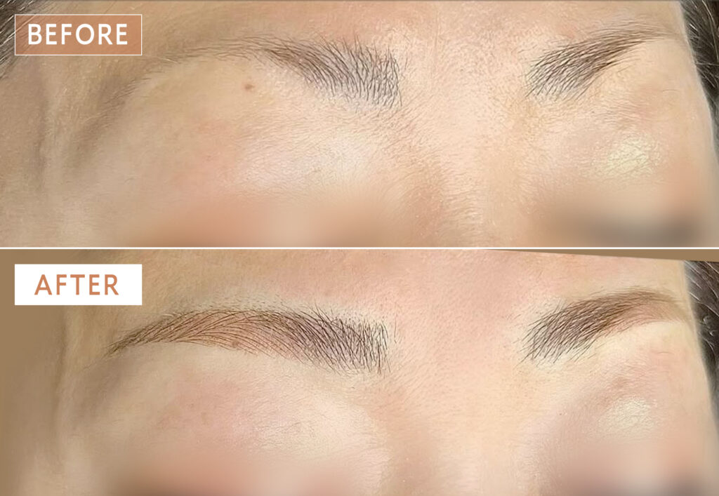 上がり眉をアートメイクでなだらかにした症例