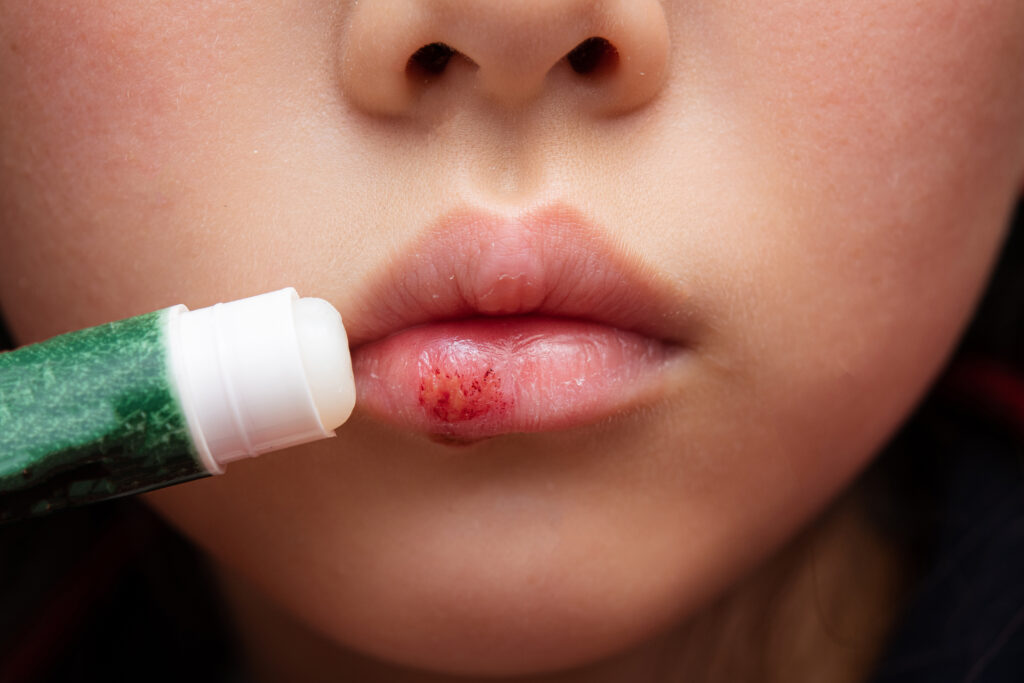 リップで唇が荒れるのはなぜ？原因から正しいケアまで徹底解説