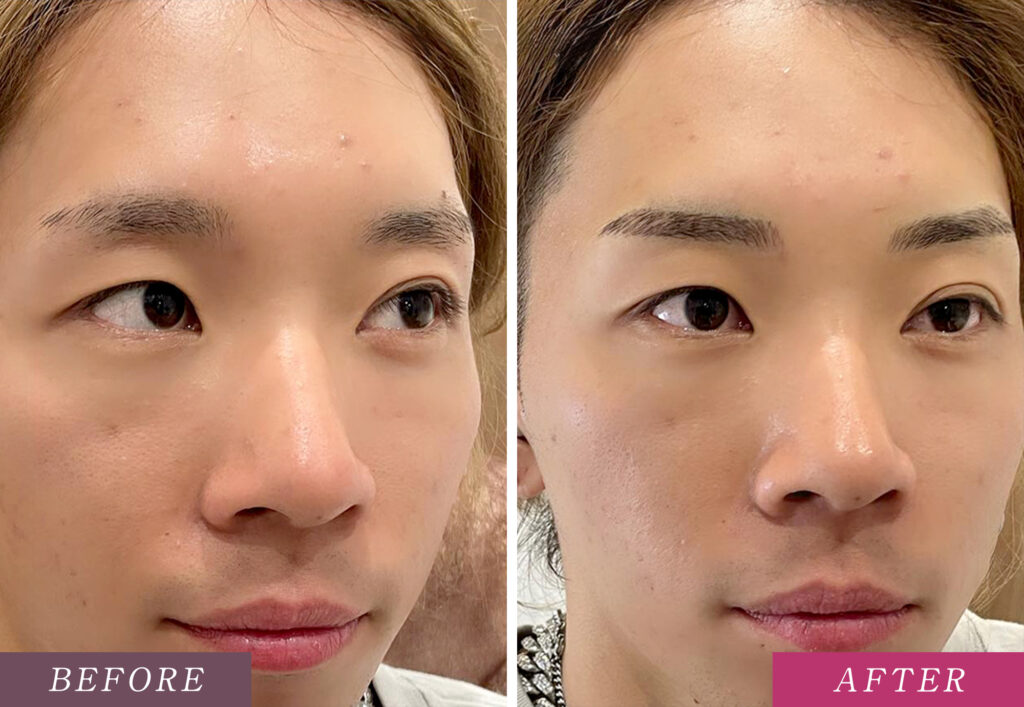 メンズの眉アートメイクの症例写真