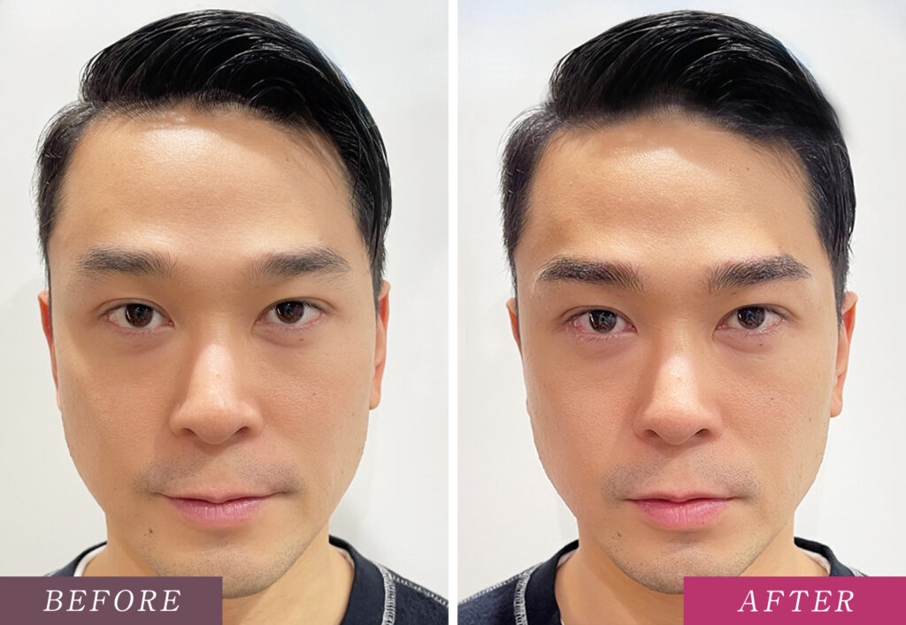 メンズの眉アートメイク症例写真