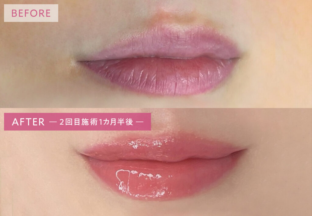 リップアートメイクの症例写真