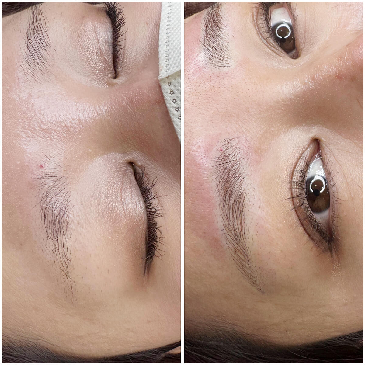 メディカルブロー 南舘 症例写真3