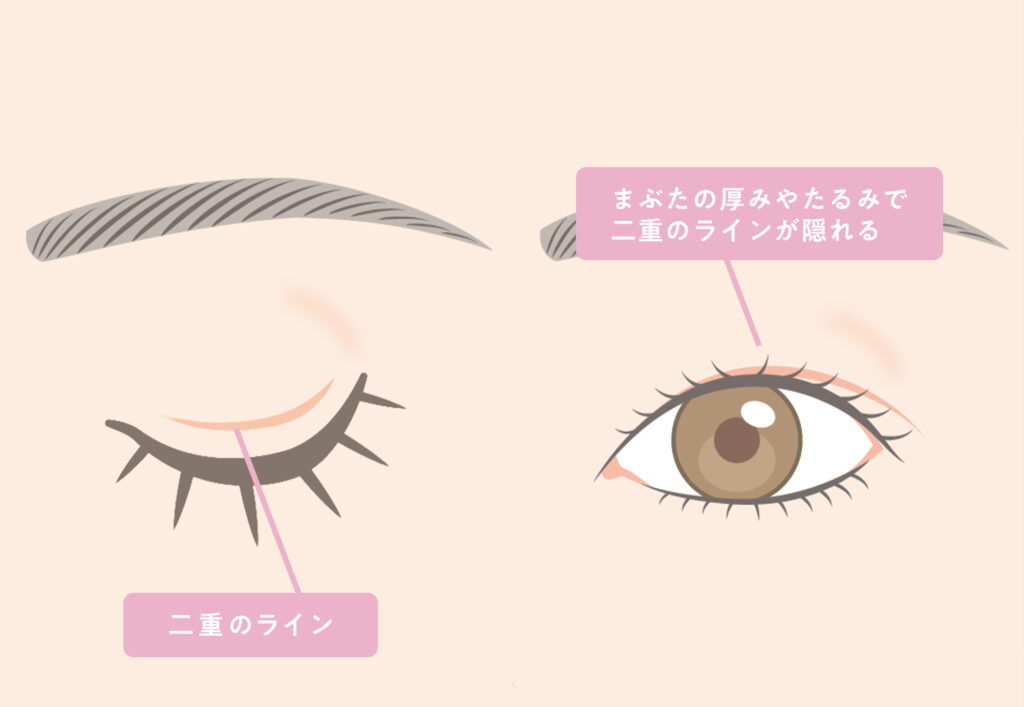 奥二重の構造図解