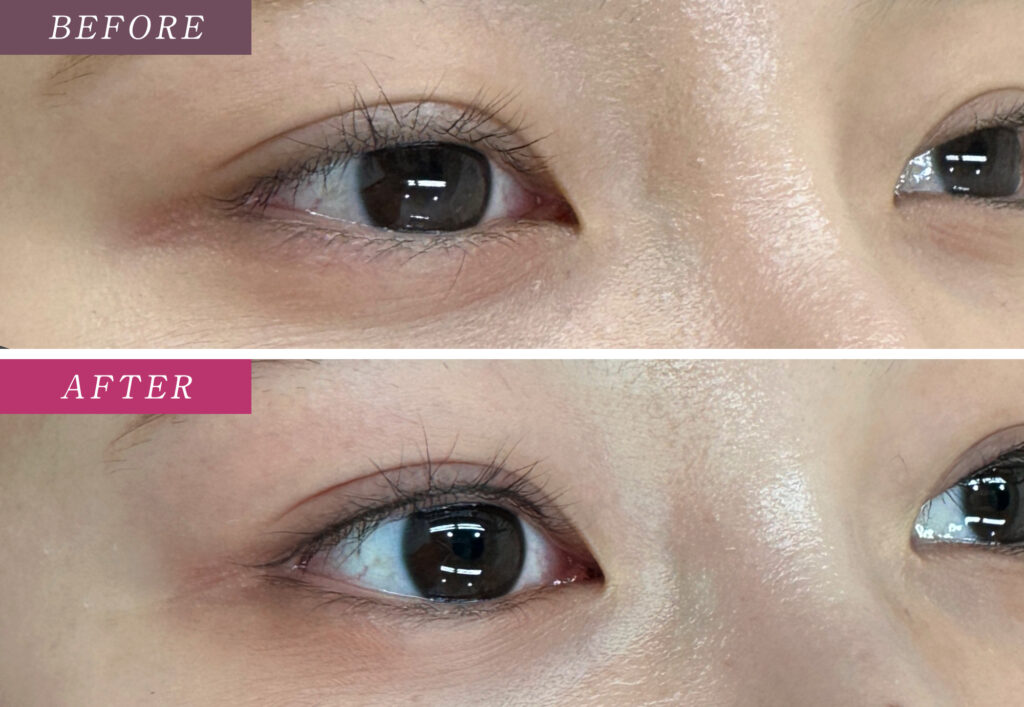 アイラインアートメイクの症例写真