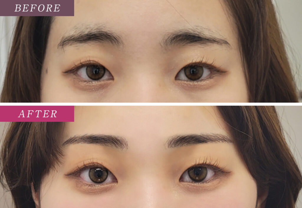 眉毛アートメイクの症例写真