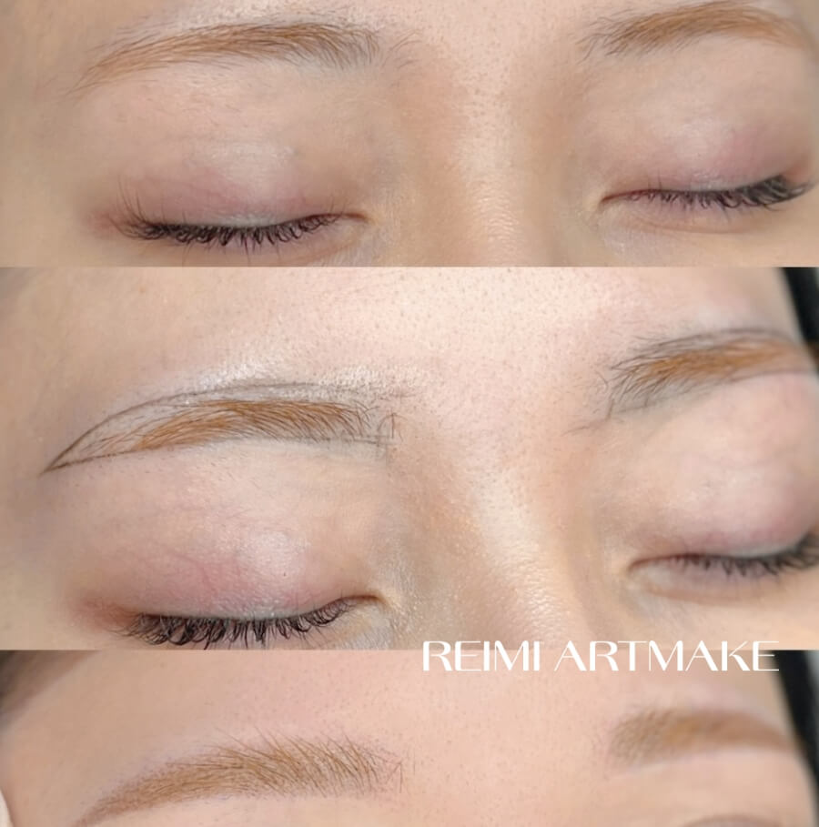 メディカルブロー フクシマレイミ 症例写真1