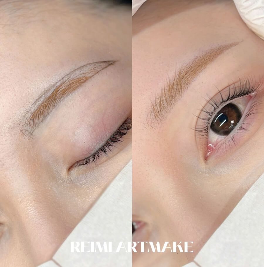 メディカルブロー フクシマレイミ 症例写真3