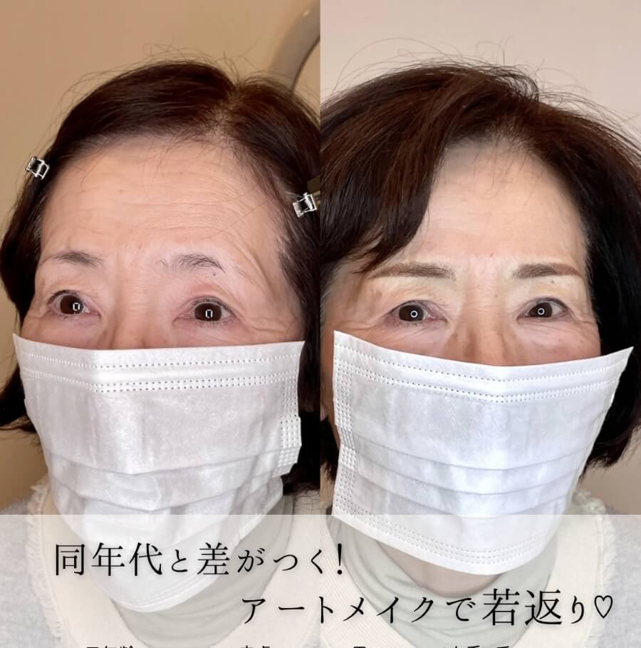 メディカルブロー 小泉 ねね 症例写真3