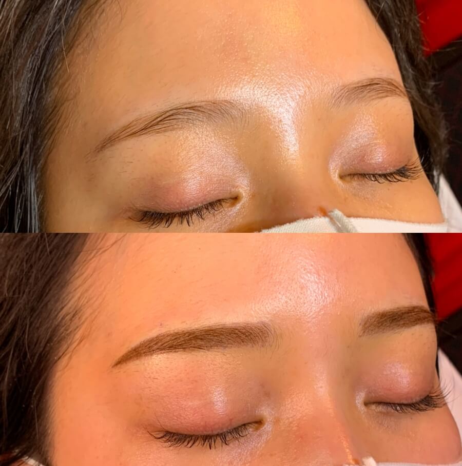 メディカルブロー 鵜澤 美保 症例写真2