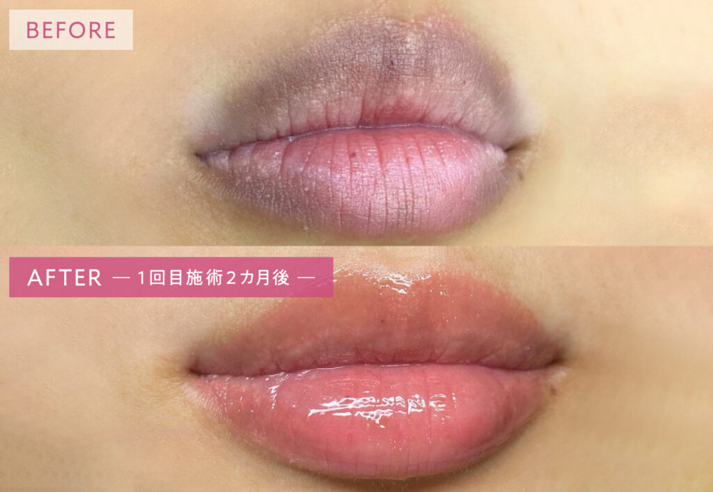 リップアートメイクの症例写真