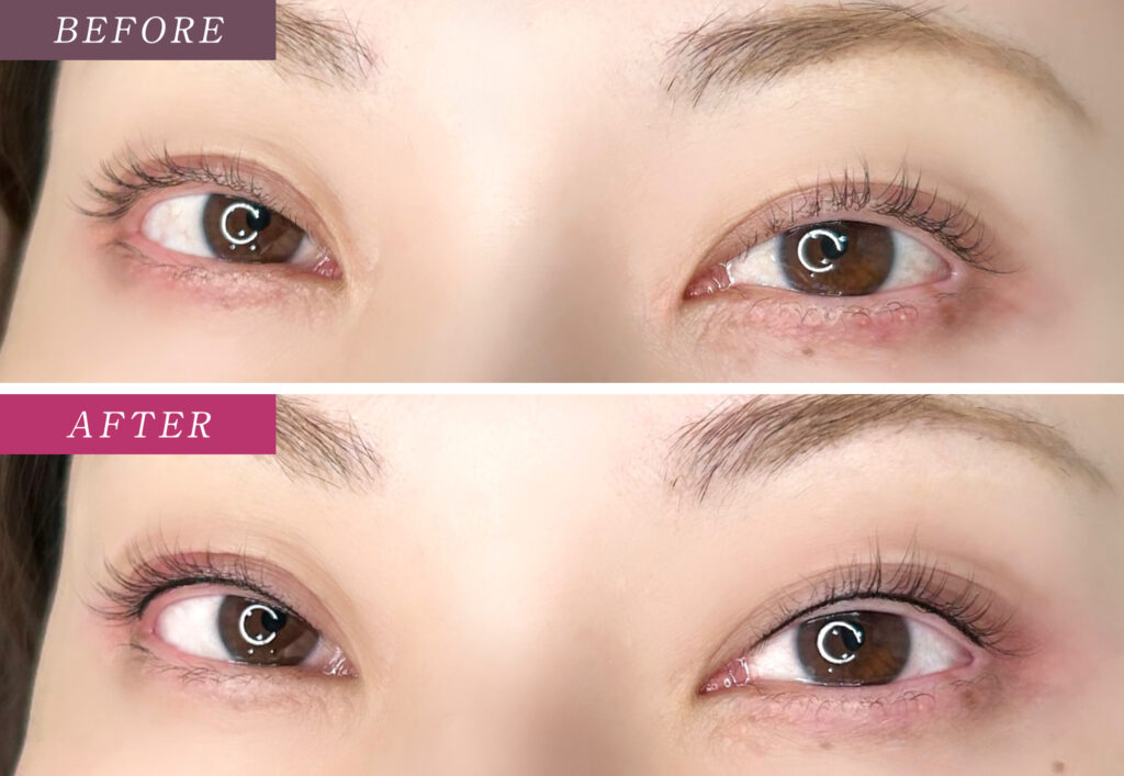 アイラインアートメイクの症例写真