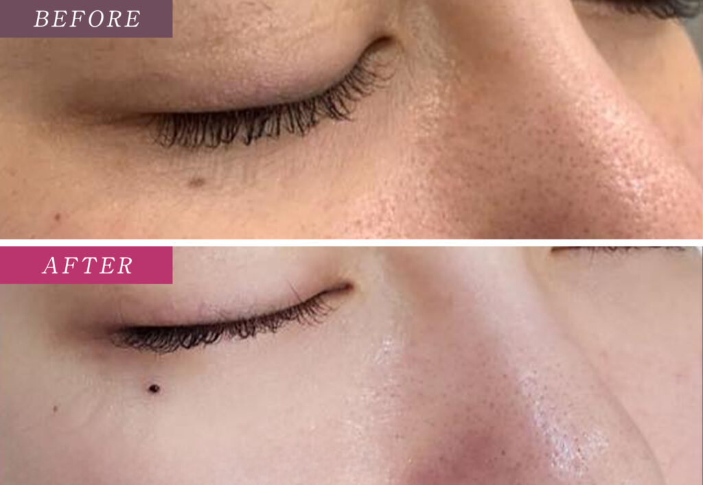 ほくろアートメイク症例写真