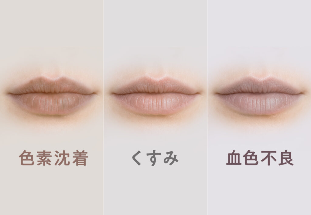 色素沈着・乾燥によるくすみ・血色不良の唇の違いの図解