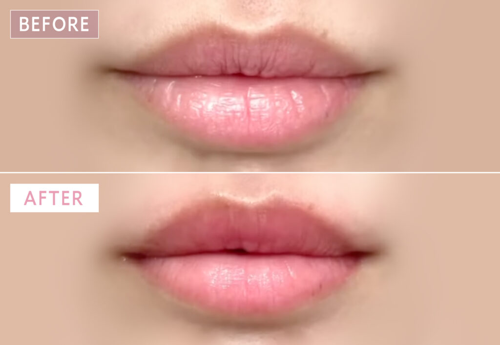 ハイドラフェイシャルパークリップの症例写真