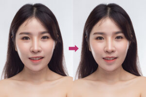 口角の左右非対称を治すには？原因と改善方法を徹底解説