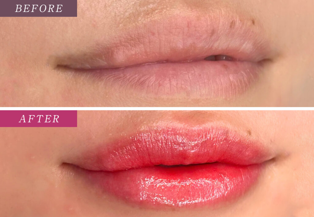 リップアートメイクの症例写真