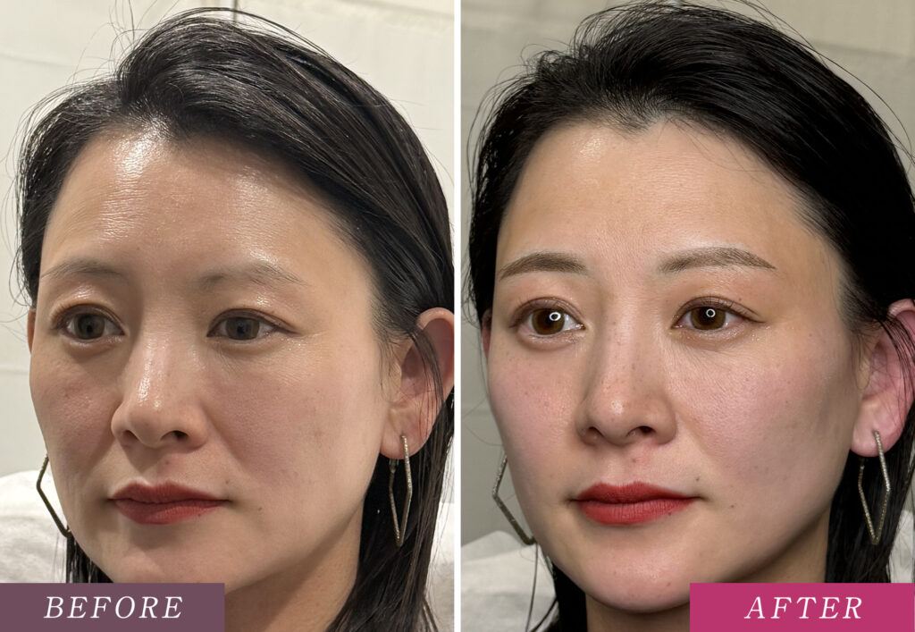 求心顔の方の眉毛アートメイク症例