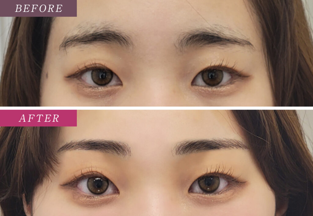 眉毛アートメイクの症例写真