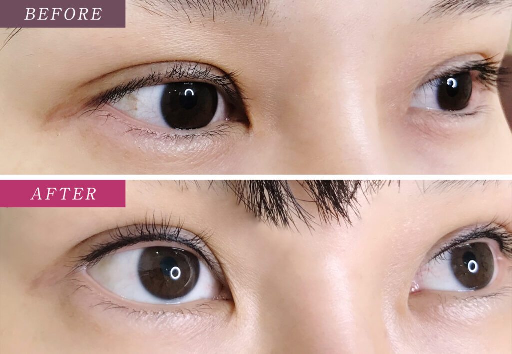 アイラインアートメイクの症例写真