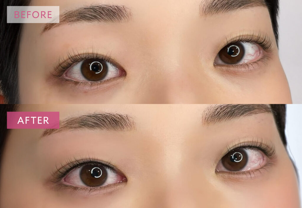 アイラインアートメイクの症例