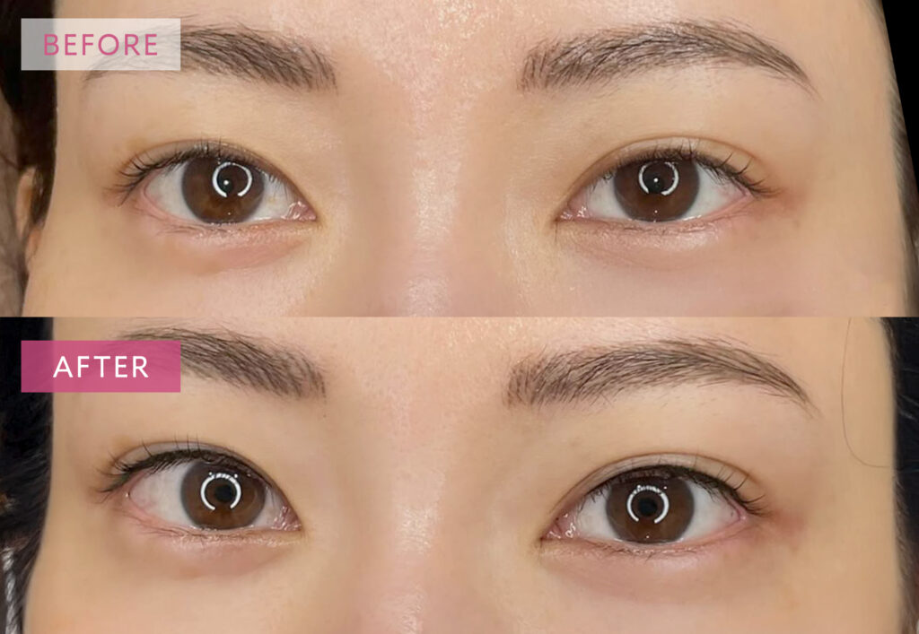 アイラインアートメイク症例写真