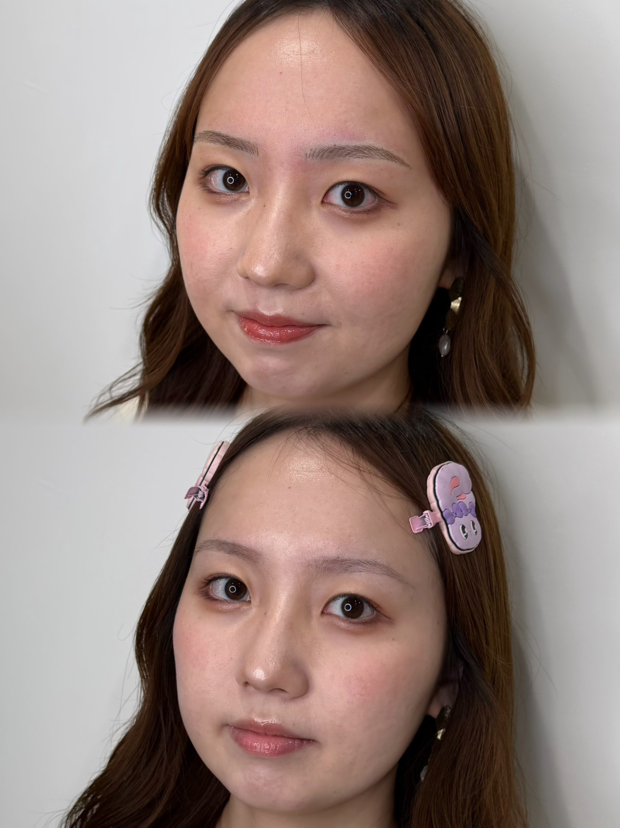 メディカルブロー 池田 症例写真2