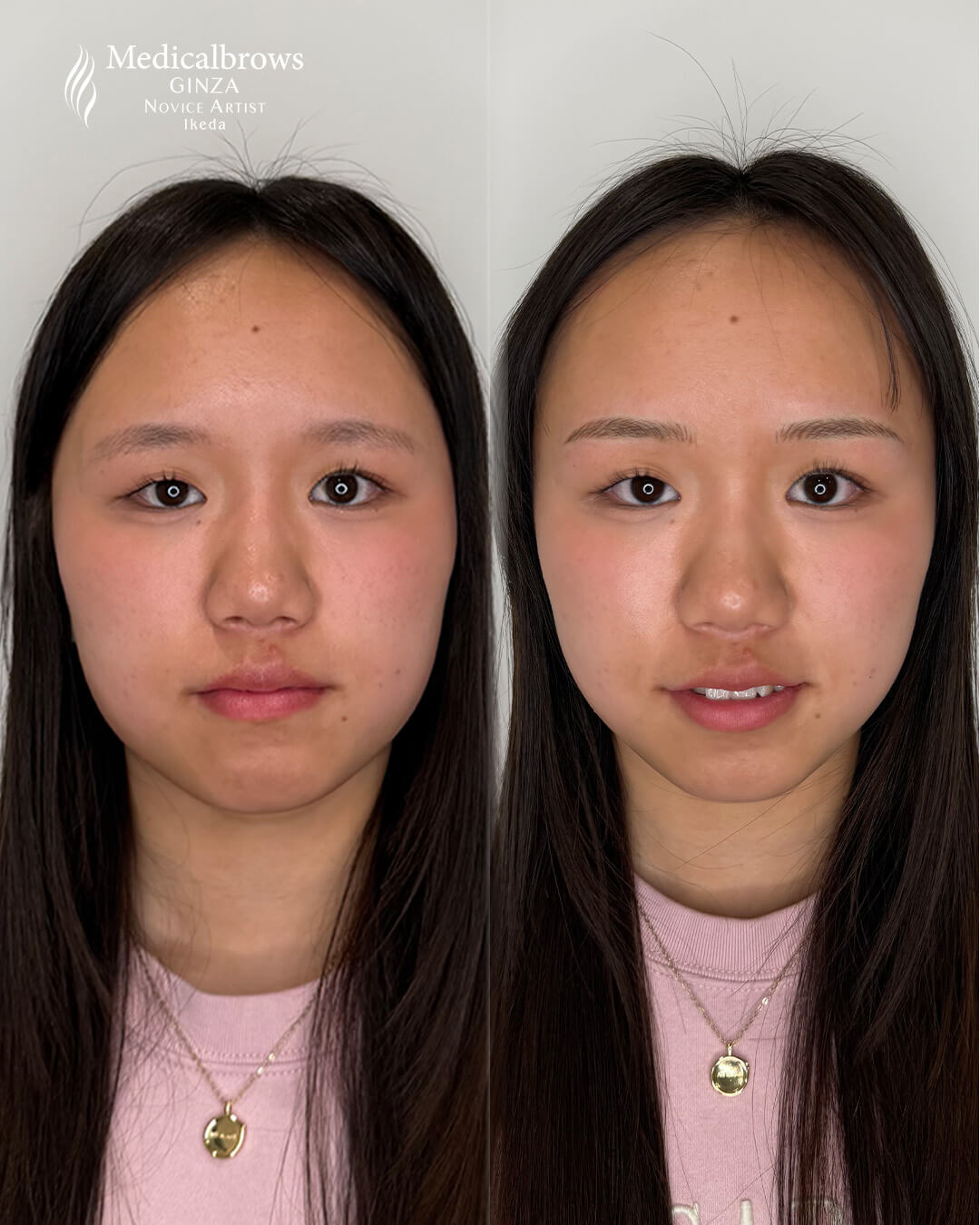 メディカルブロー 池田 症例写真2