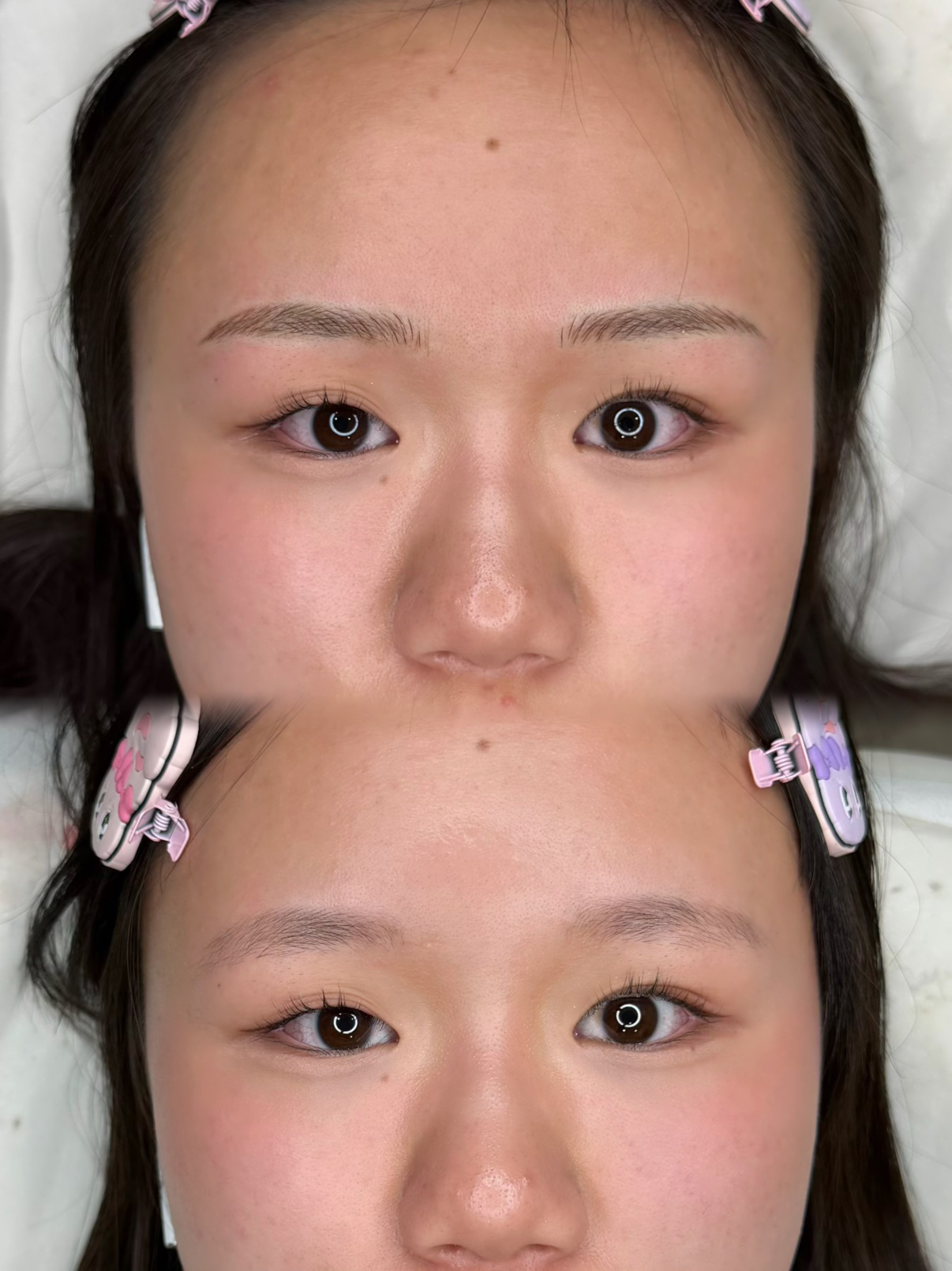 メディカルブロー 池田 症例写真3