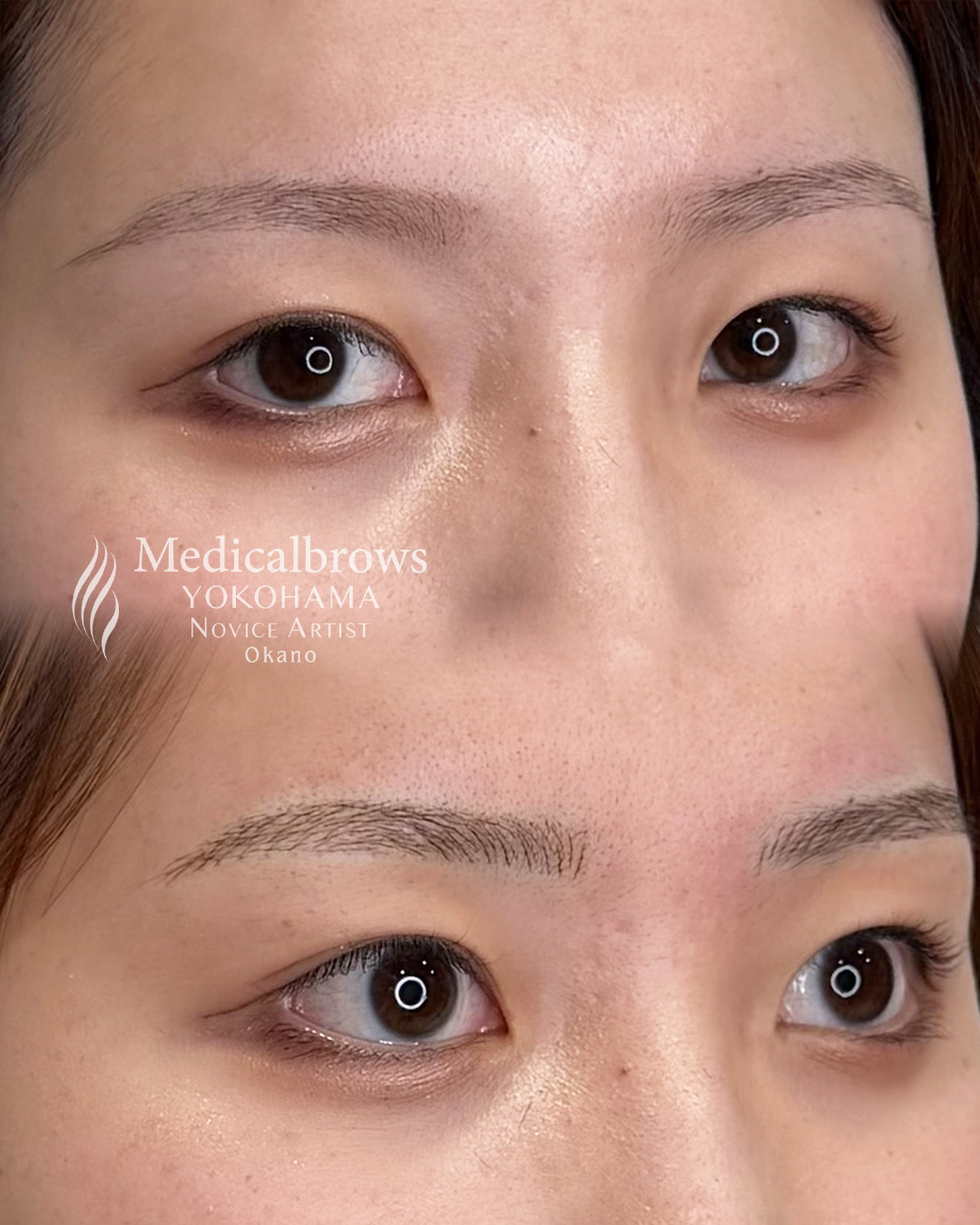 メディカルブロー 岡野 症例写真1