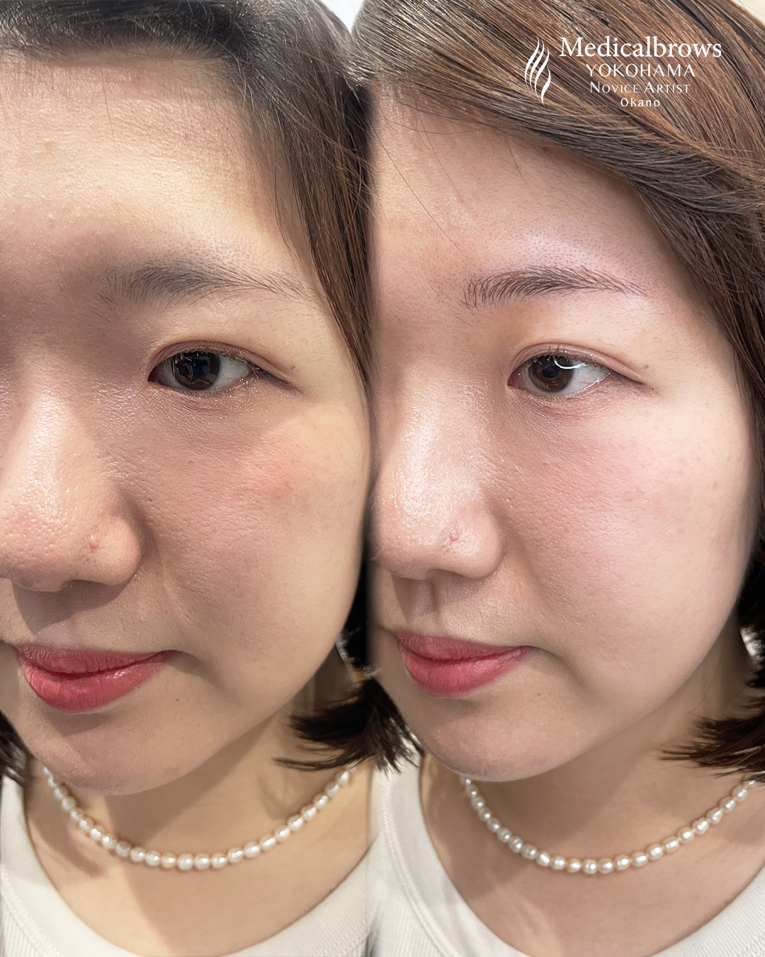 メディカルブロー 岡野 症例写真3