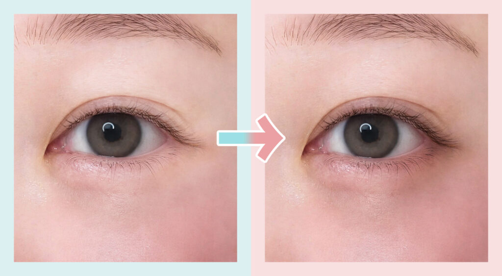 まつ毛美容液による色素沈着の例