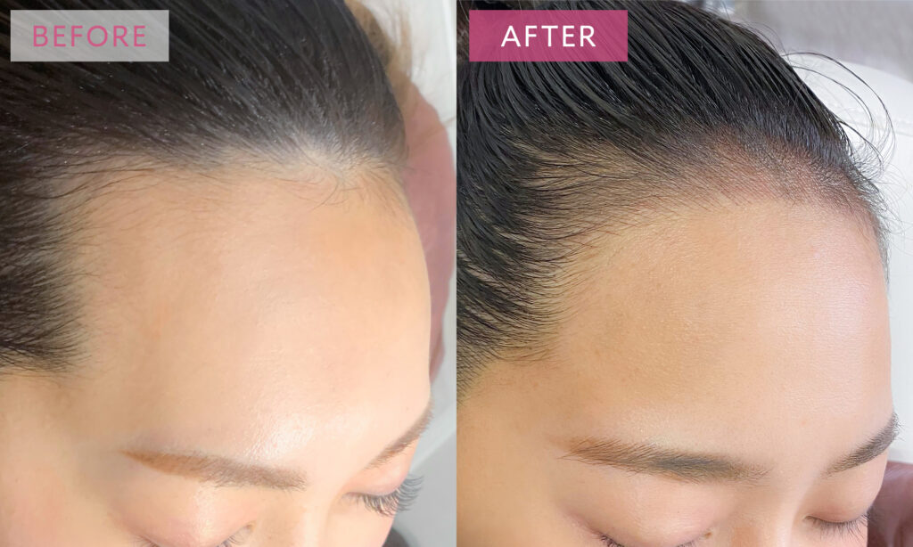 ヘアラインアートメイクの症例写真