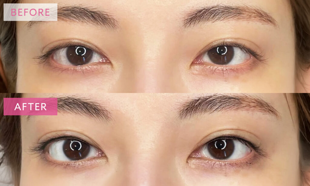 アイラインアートメイクの症例写真