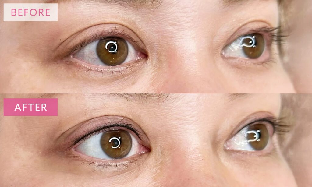 アイラインアートメイクの症例写真